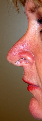 Revision Rhinoplasty