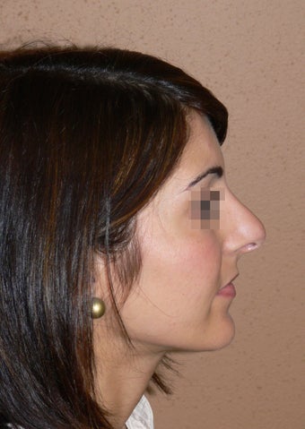 Rhinoplasty/nose job surgery
