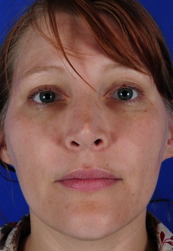 Revision Rhinoplasty