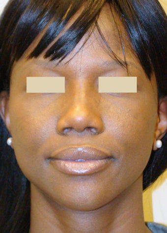 African American Rhinoplasty