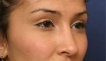 Rhinoplasty