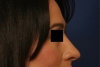 Rhinoplasty