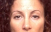 Rhinoplasty