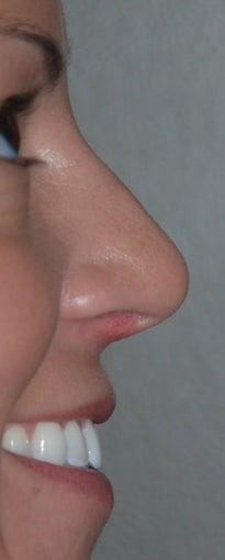 Rhinoplasty - Hump Reduction, Lift Drooping Tip