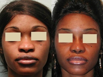 African American Rhinoplasty