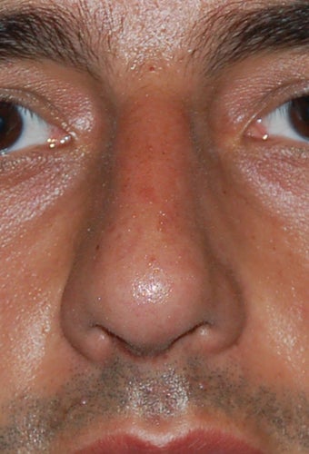 Rhinoplasty, Deviated Septum