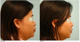 Dallas Asian Rhinoplasty
