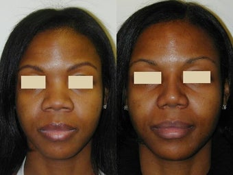 African American Rhinoplasty