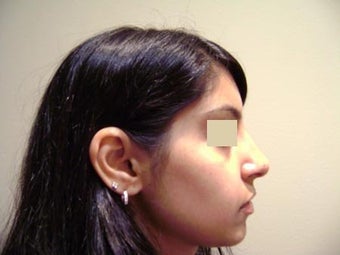 Rhinoplasty
