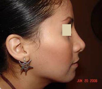 Rhinoplasty