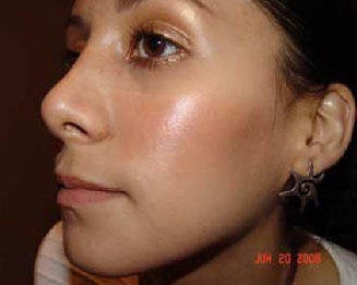Rhinoplasty
