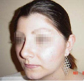 Rhinoplasty