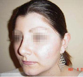Rhinoplasty