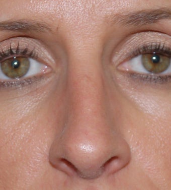 Open Rhinoplasty