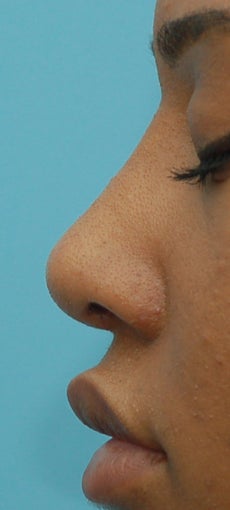 Rhinoplasty