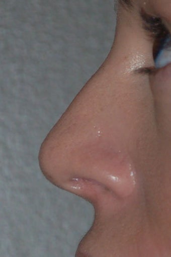 Rhinoplasty