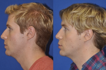 Endonasal Rhinoplasty