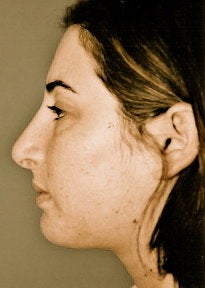 Rhinoplasty