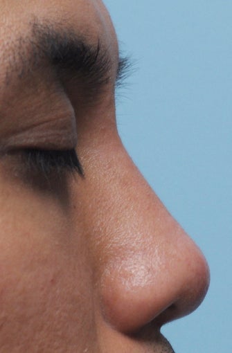 Non Surgical Rhinoplasty