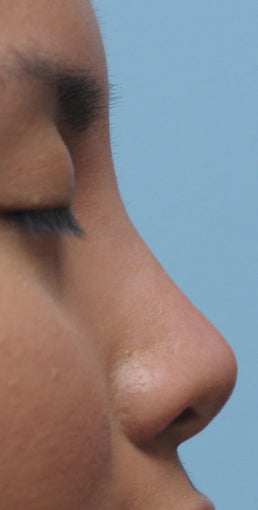 Non Surgical Rhinoplasty