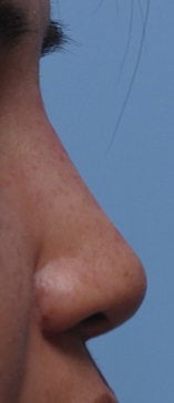 Non Surgical Rhinoplasty