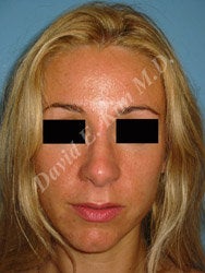 Rhinoplasty