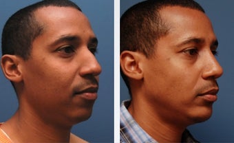 Rhinoplasty