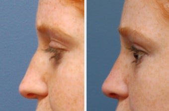 Rhinoplasty