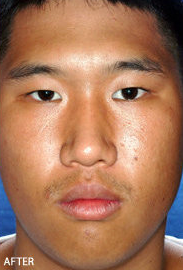 Rhinoplasty