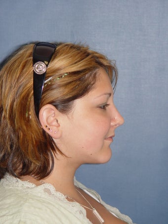 Rhinoplasty, Neck Liposuction & Chin Implant