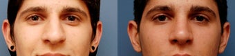 Rhinoplasty, Ethnic Iranian