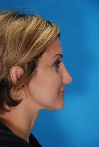 Rhinoplasty (nose job, nasal surgery)
