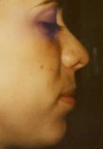 Rhinoplasty