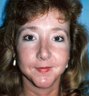 Rhinoplasty