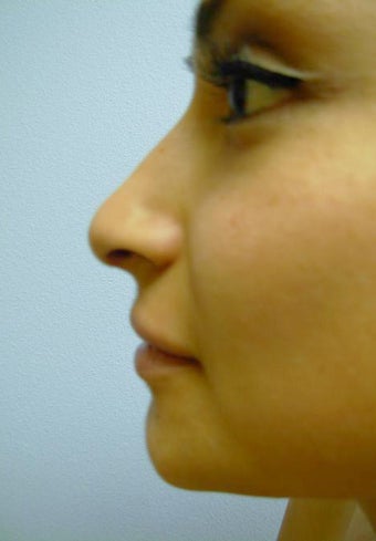 Rhinoplasty