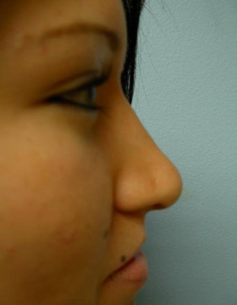 Rhinoplasty