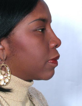 Rhinoplasty
