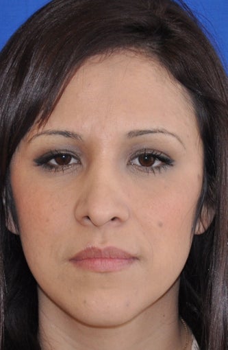 Rhinoplasty