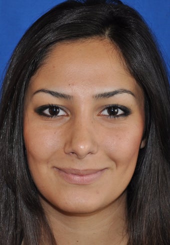 Rhinoplasty