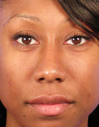 Rhinoplasty