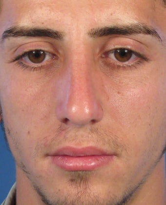 Rhinoplasty