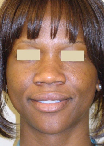 African American Rhinoplasty