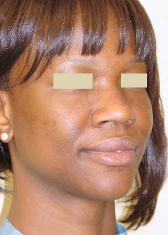 African American Rhinoplasty