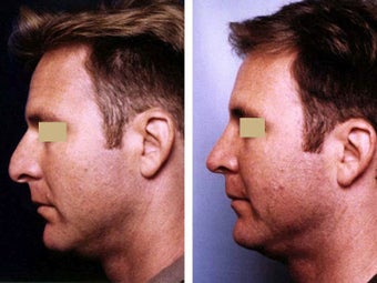Rhinoplasty