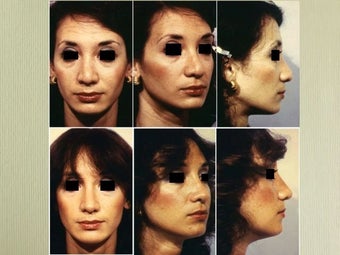 Rhinoplasty