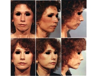 Rhinoplasty