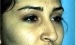 Rhinoplasty