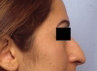 Rhinoplasty