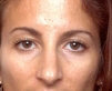 Rhinoplasty