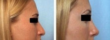 Rhinoplasty